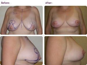 breast-reduction-1bigger